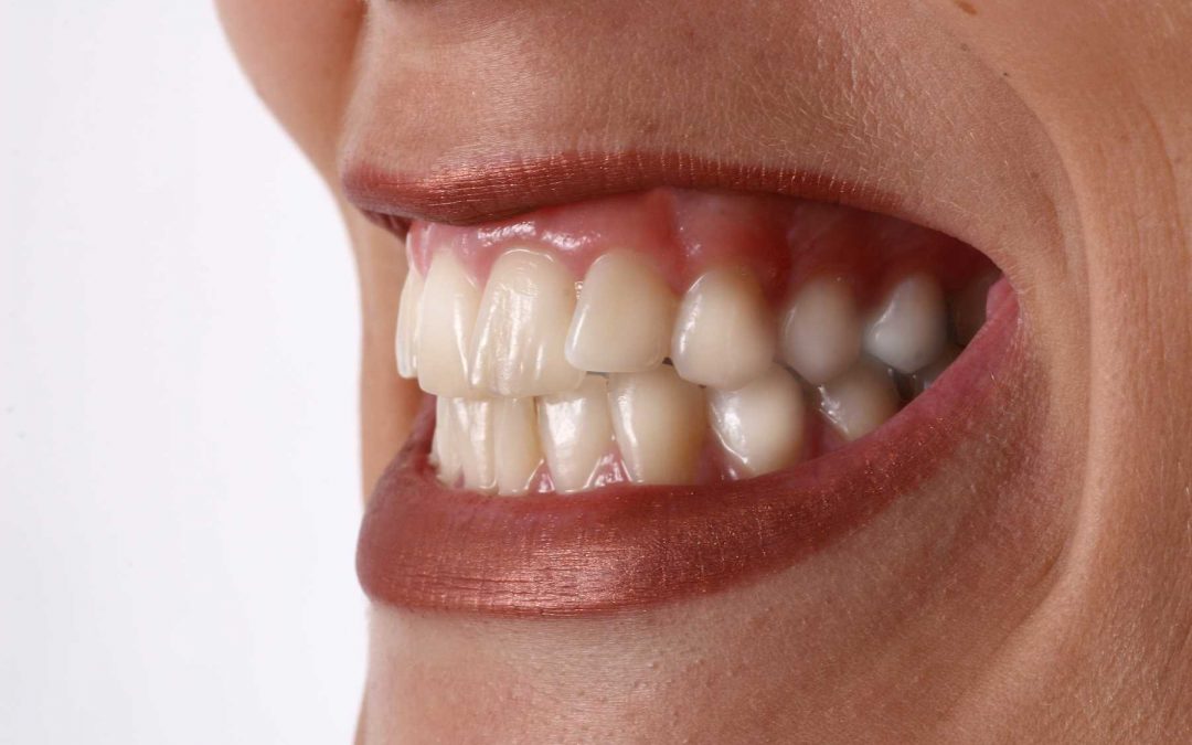 Warum ist es so schwierig vom Zähneknirschen loszukommen?