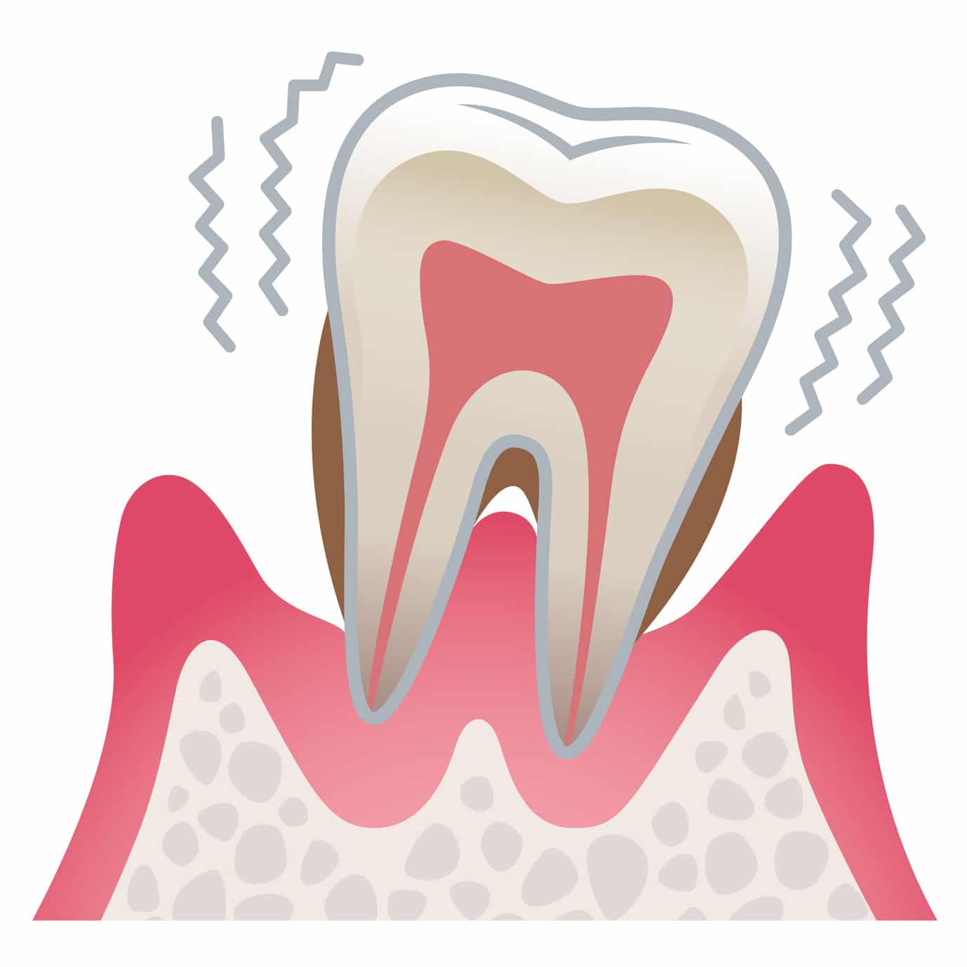 Zahn im Zahnfleisch