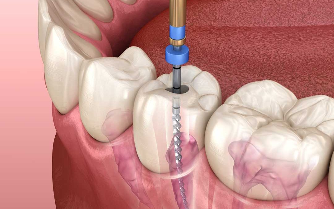 Was ist eine Wurzelbehandlung bei einem Zahn?