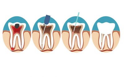 Warum tut ein toter Zahn noch weh?