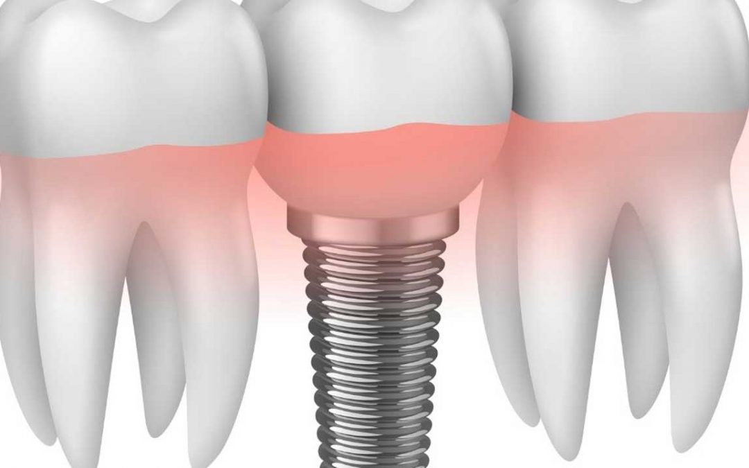 Die 10 häufigsten Fragen zu Zahnimplantaten